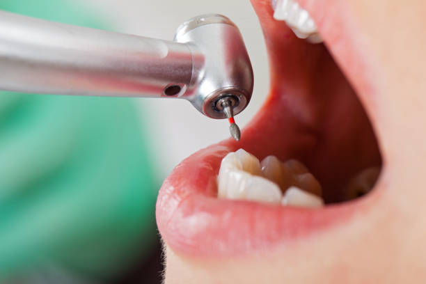 Best Emergency Dentist for Knocked-Out Tooth in Bangor Base, WA